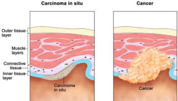 carcinoma in situ