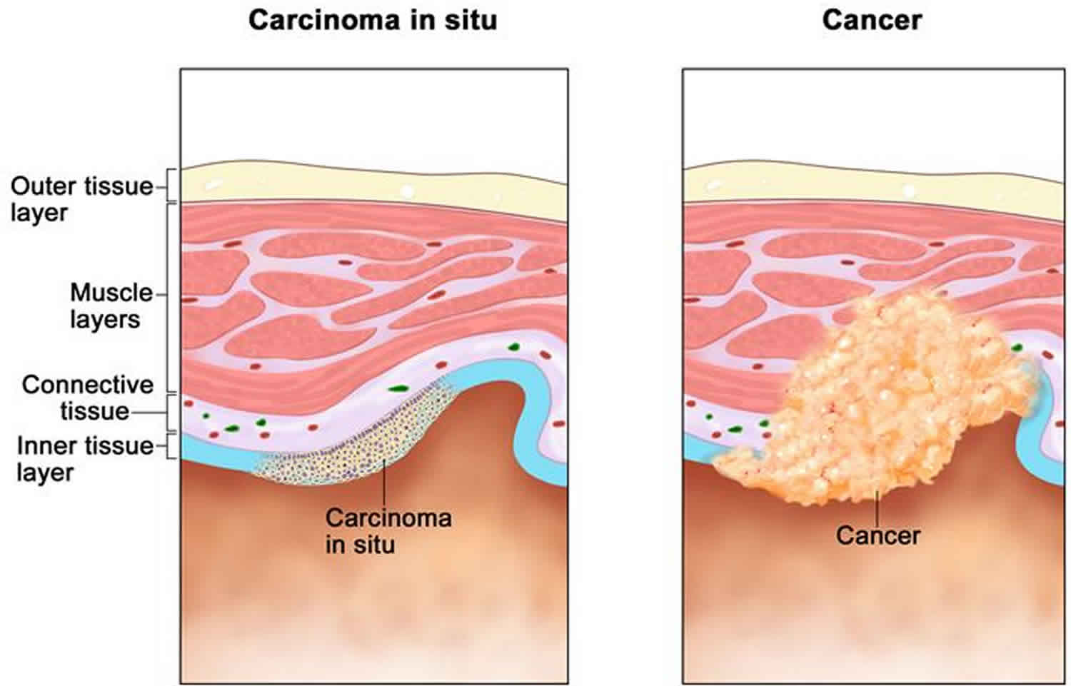 Can Ductal Carcinoma In Situ Come Back