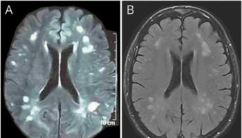 cerebral edema