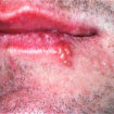 cold sores