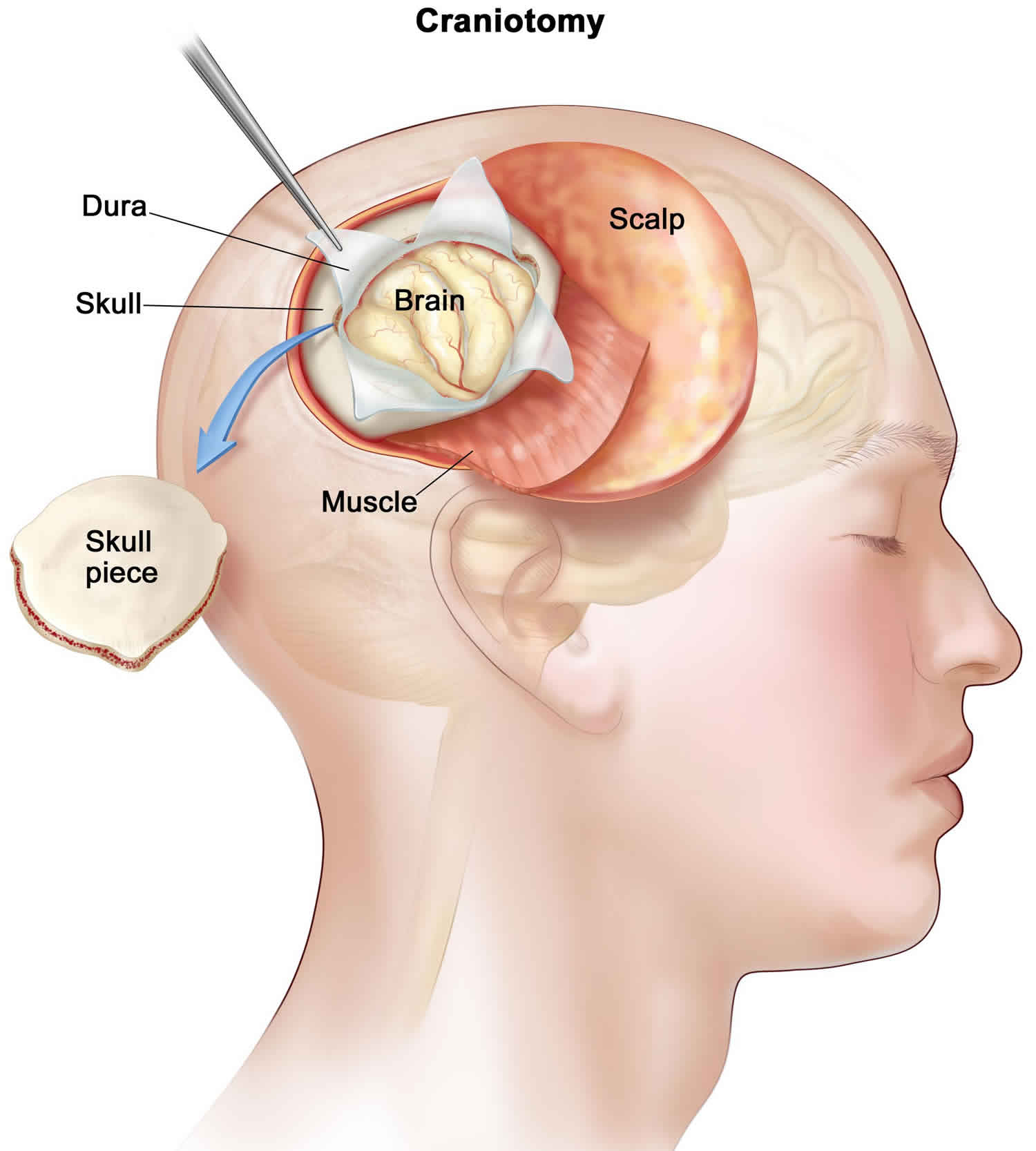 craniotomy