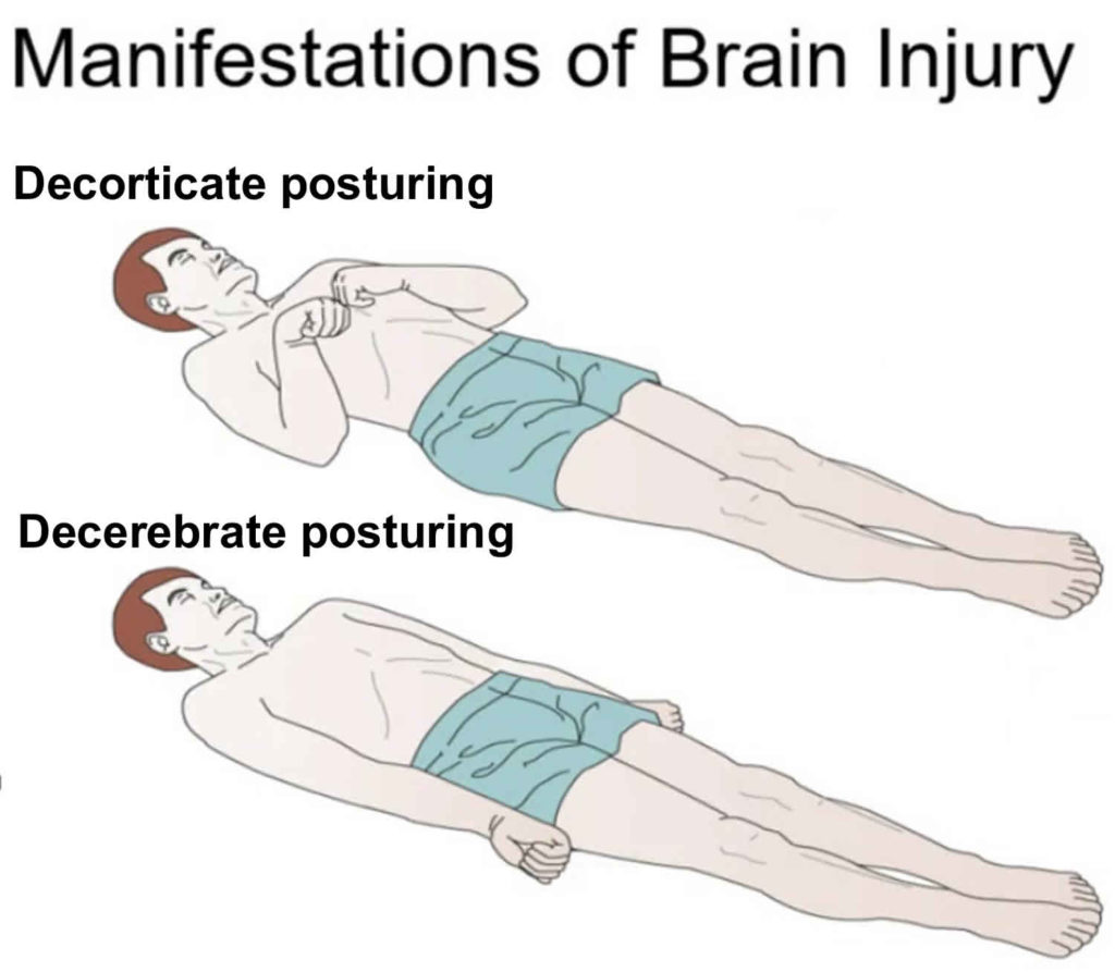 Decorticate and decerebrate posturing causes & treatment