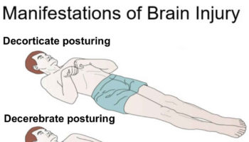 decorticate and decerebrate posturing