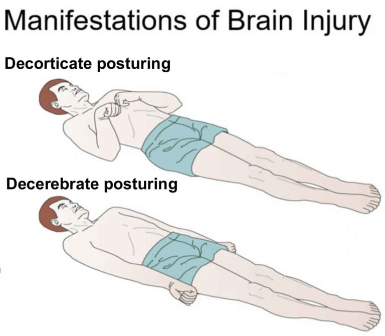 Decorticate And Decerebrate Posturing Causes Treatment   Decorticate And Decerebrate Posturing 768x670 