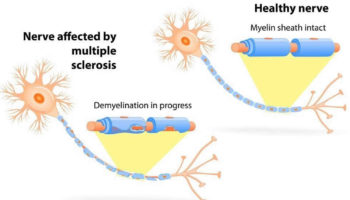 demyelination