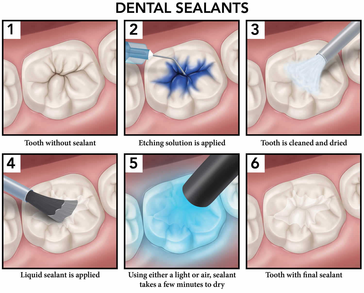 Dental sealants procedure