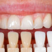 dental veneers