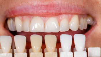 dental veneers