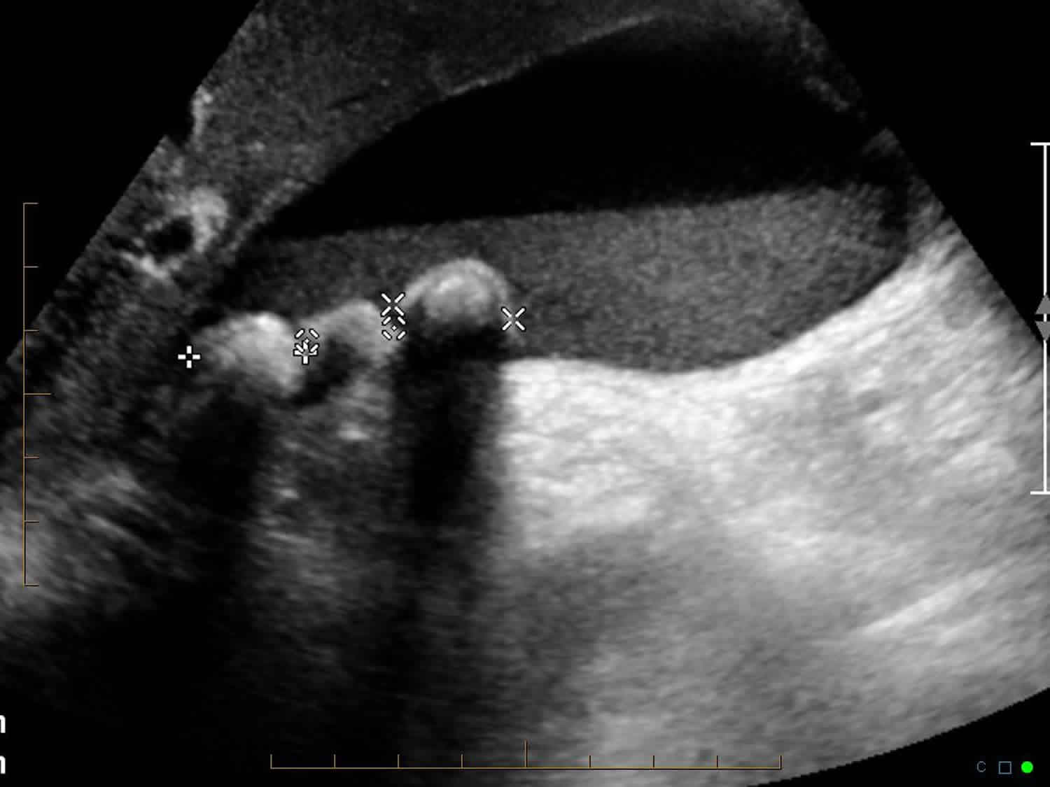 gall-bladder-is-well-distended-wall-of-normal-thickness-an-echogenic