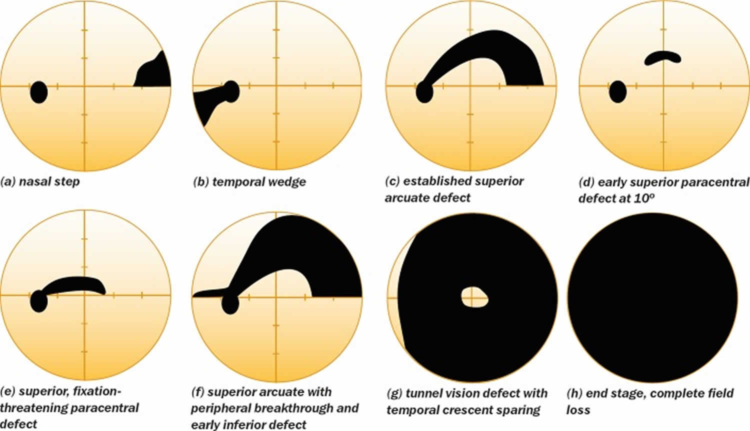 Visual field test, visual field test results interpretation