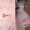 hamartoma