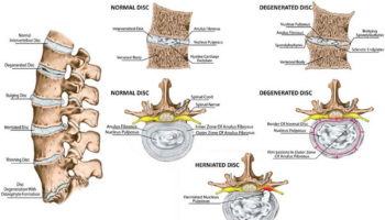 intervertebral disc