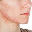 isotretinoin