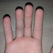 jammed finger