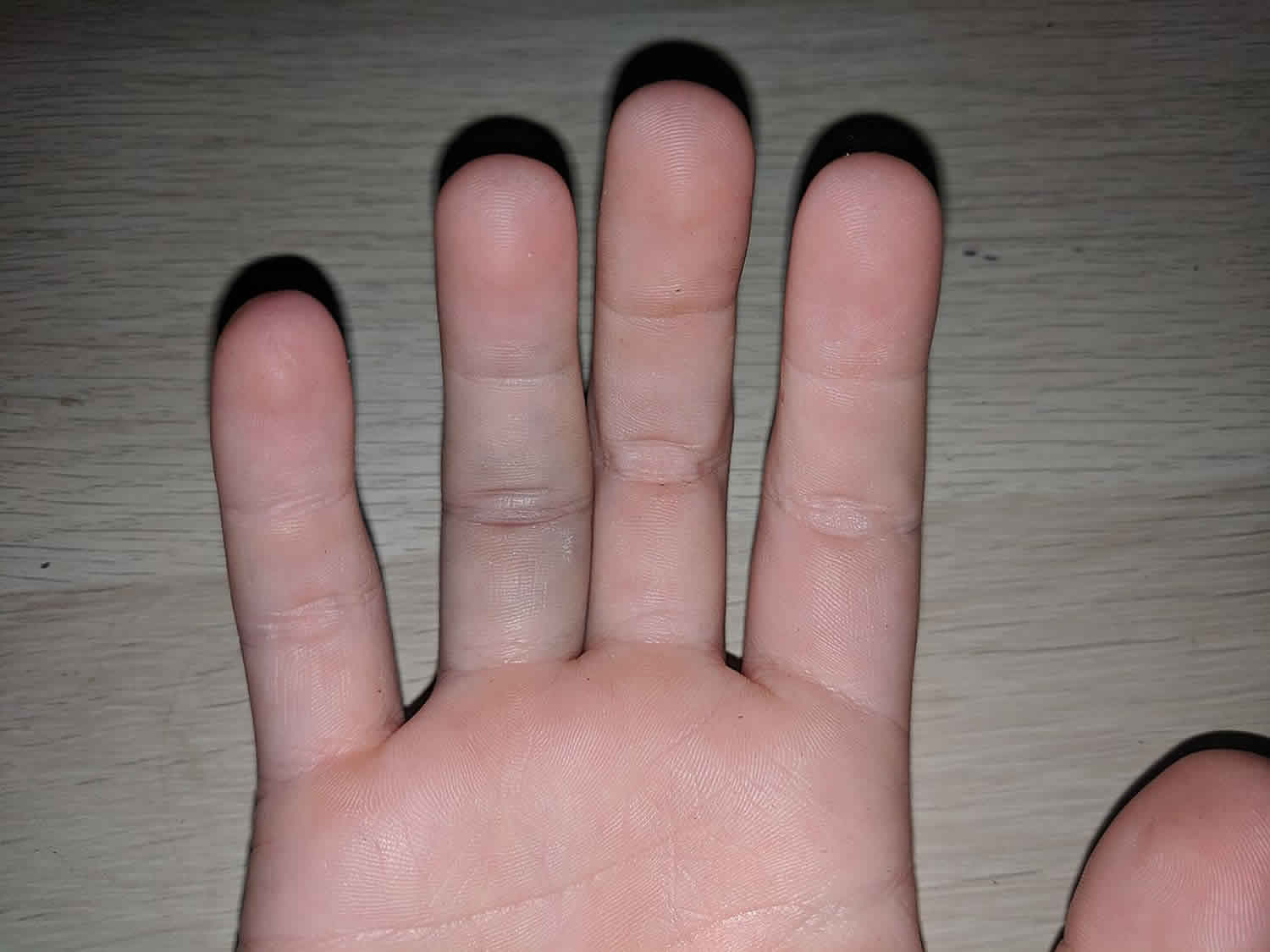 What Does A Jammed Finger Look And Feel Like