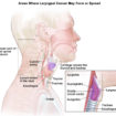 laryngeal cancer