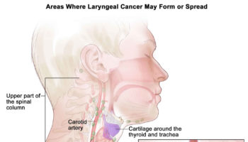 laryngeal cancer