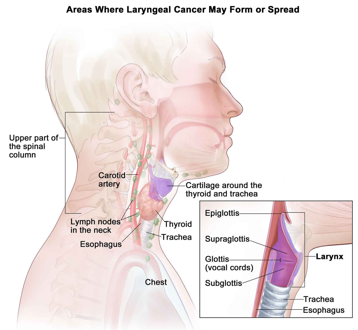 Laryngeal Cancer Causes Signs Symptoms Diagnosis Treatment