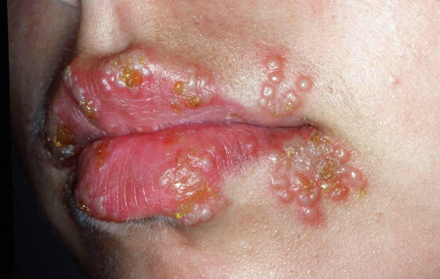 Cold sores also called fever blisters, are caused by a contagious virus cal...