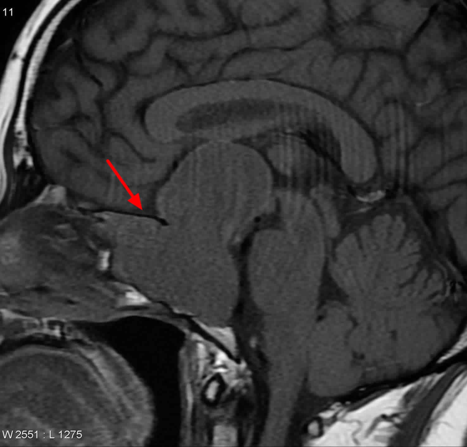 Pituitary adenoma MRI