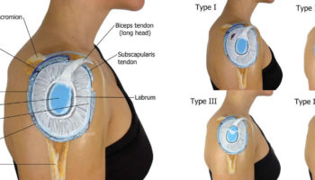 shoulder labrum tear