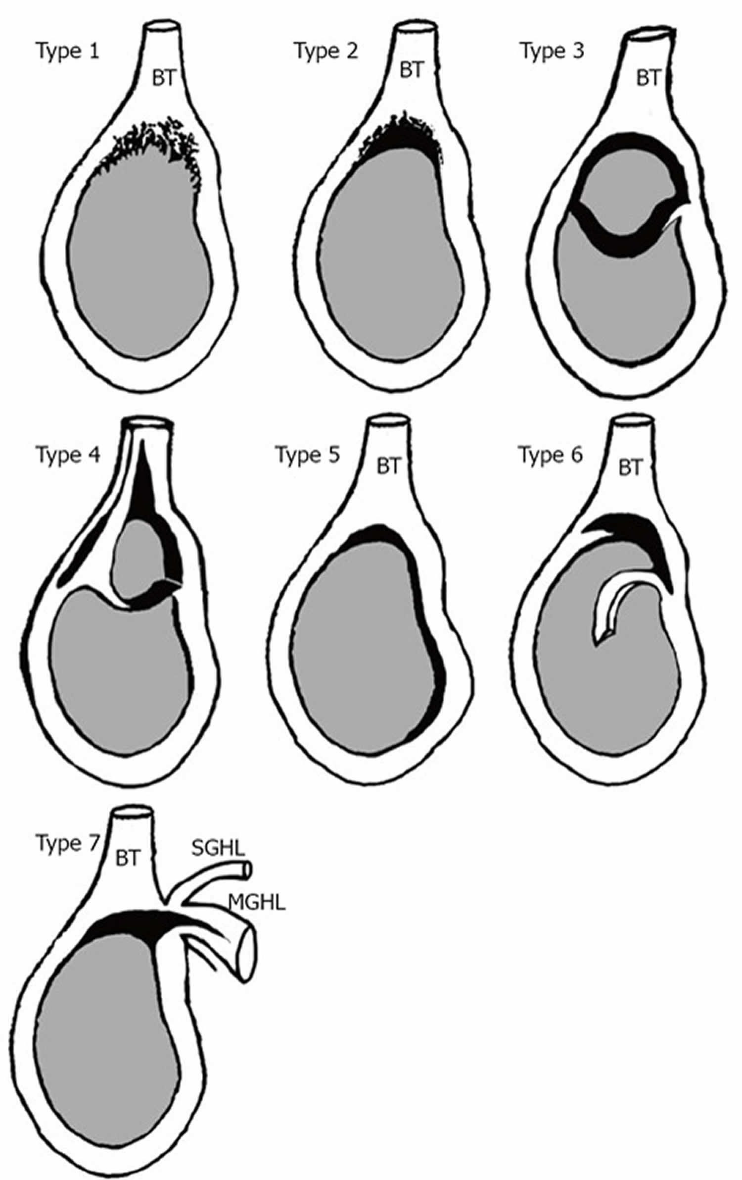 Labrum Cartilage Tear Shoulder Causes Symptoms Diagnosis Treatment