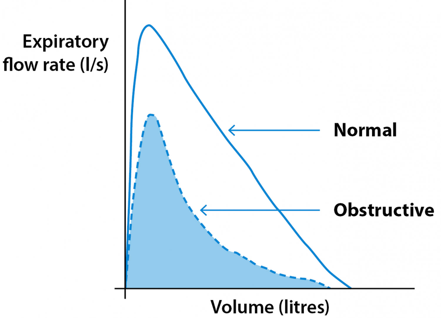 Spirometry Obstructive pattern