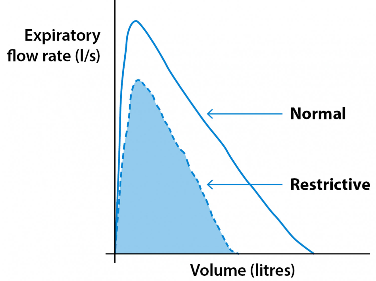 spirometry restrictive pattern