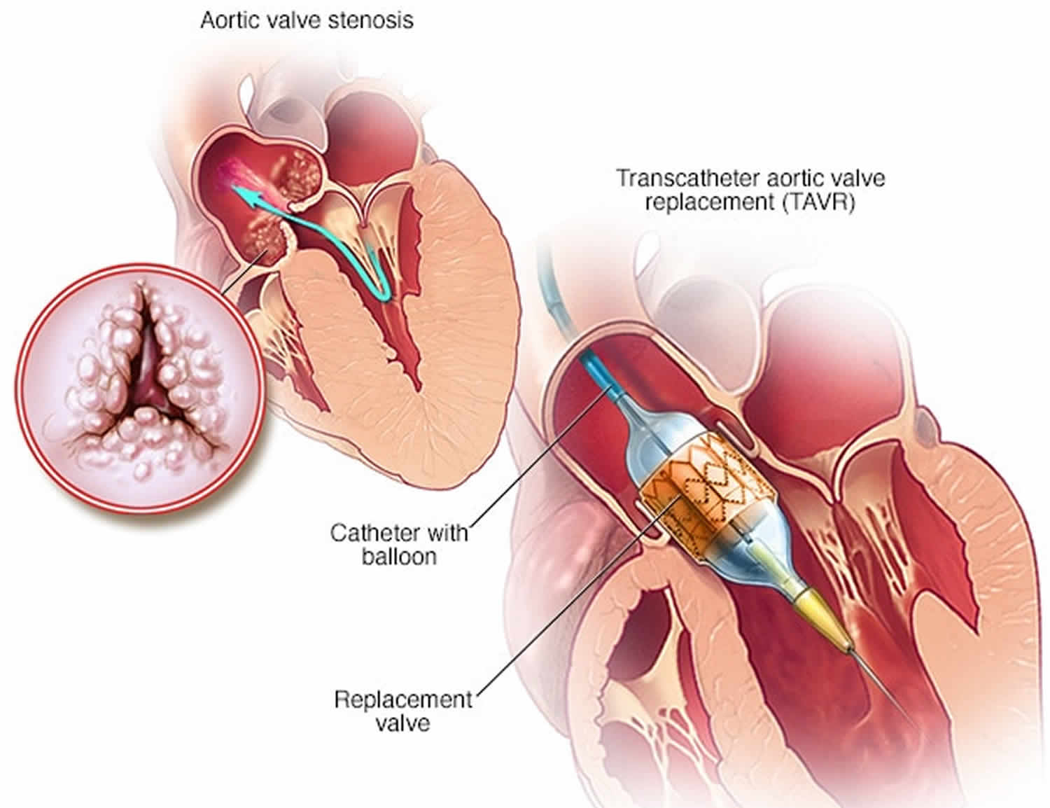 transcatheter aortic valve replacement
