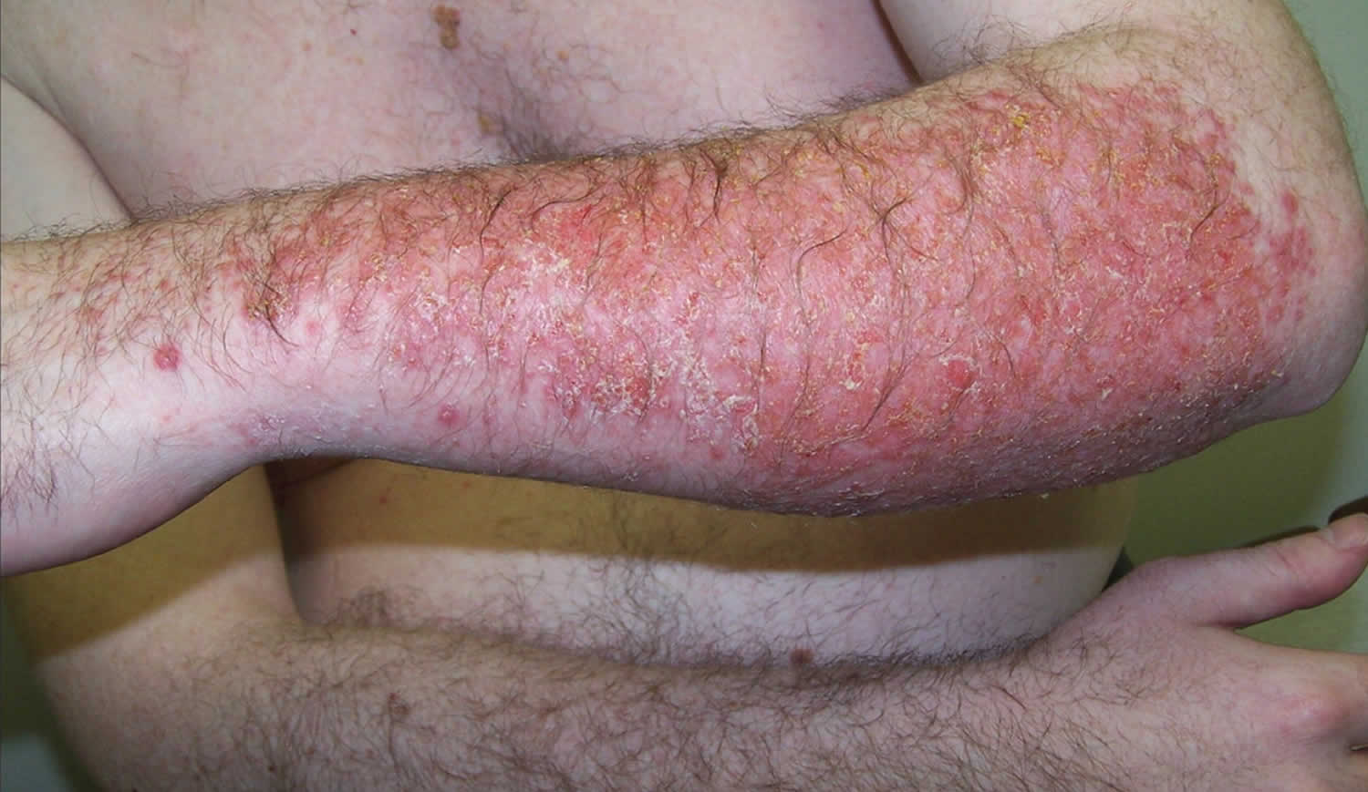 Mild Contact Dermatitis