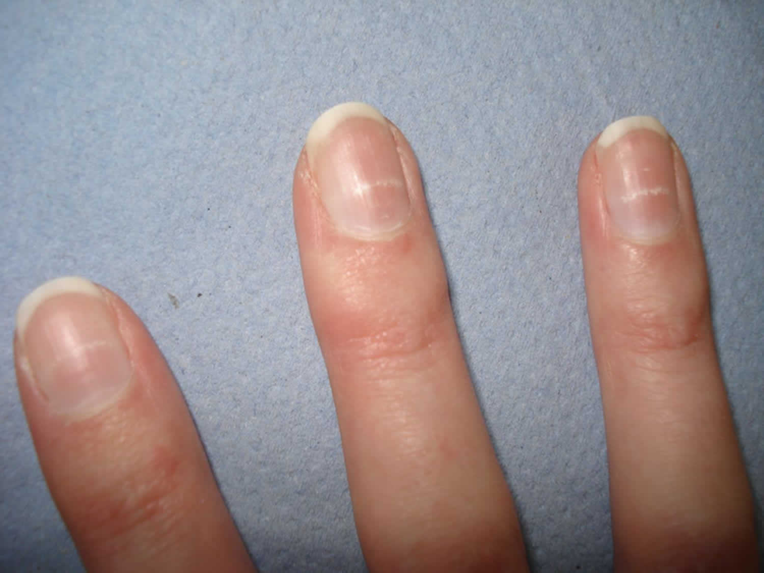 3. How to Get Rid of Beau's Lines on Nails - wide 6