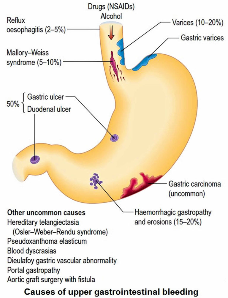 melena medical definition        
        <figure class=