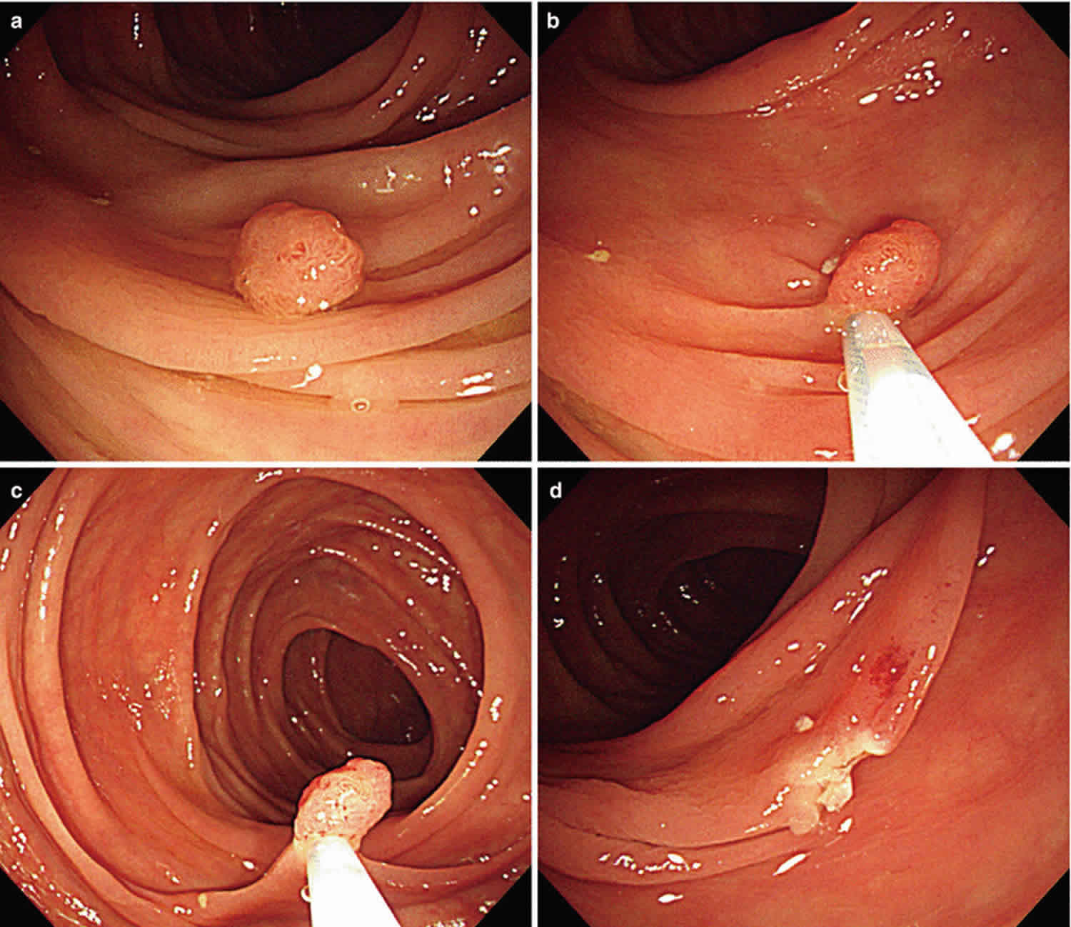 what is a colonoscopy with polypectomy