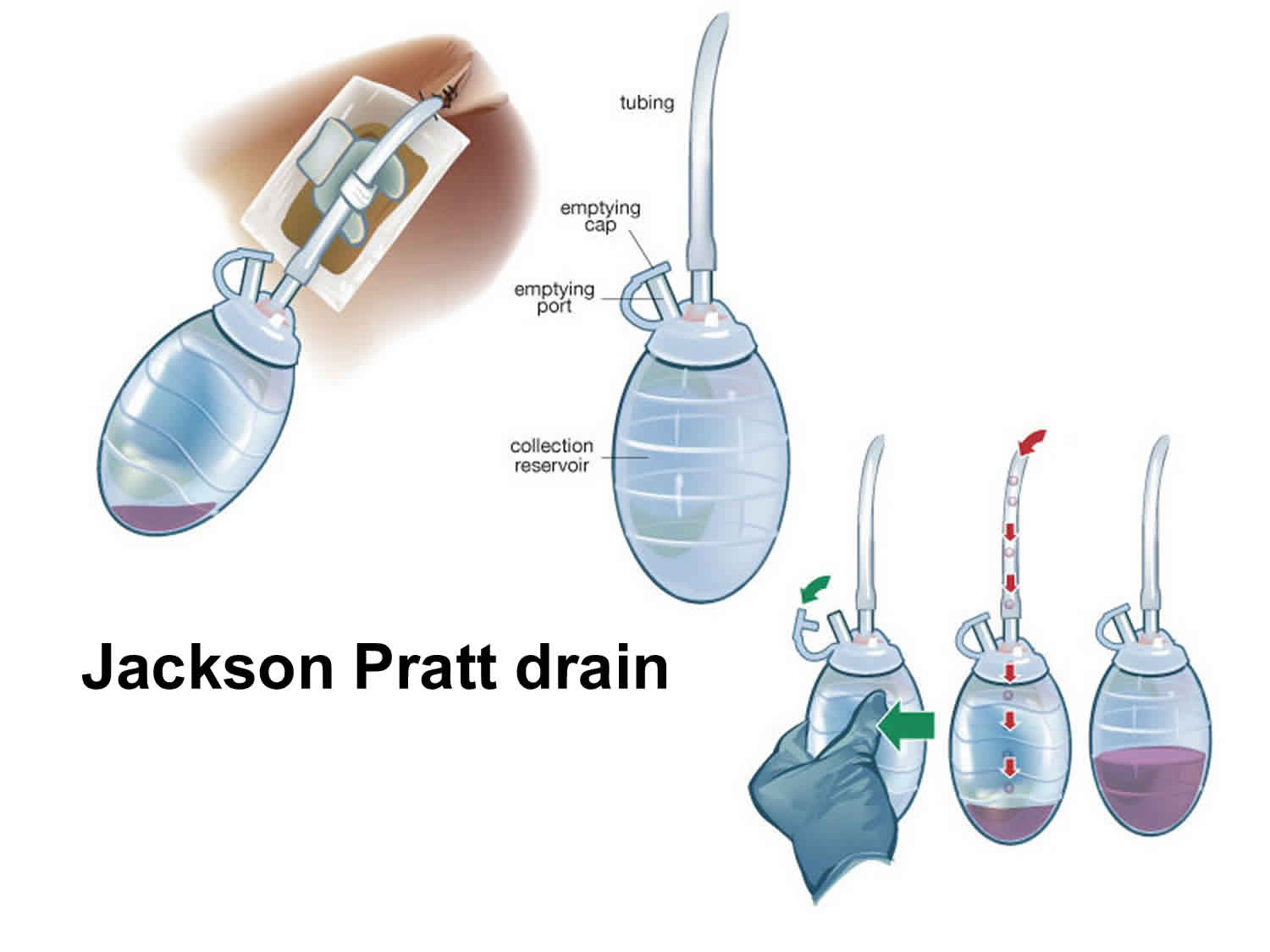 Jackson-Ppratt drain