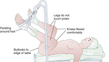 Lithotomy position