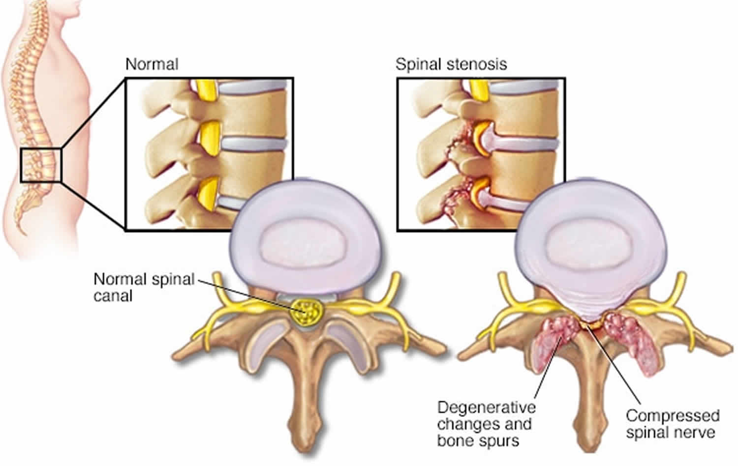 Lumbar neural foraminal stenosis