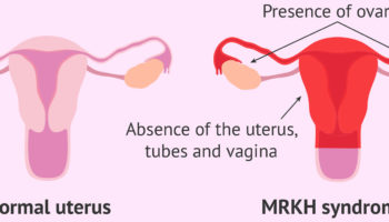 Testicular torsion causes, signs, symptoms, diagnosis, treatment & surgery