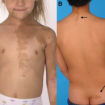 McCune Albright syndrome