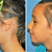 Microtia