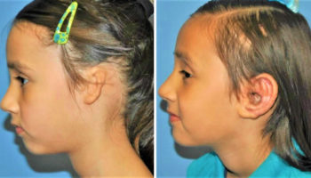 Microtia