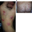 Morgellons disease