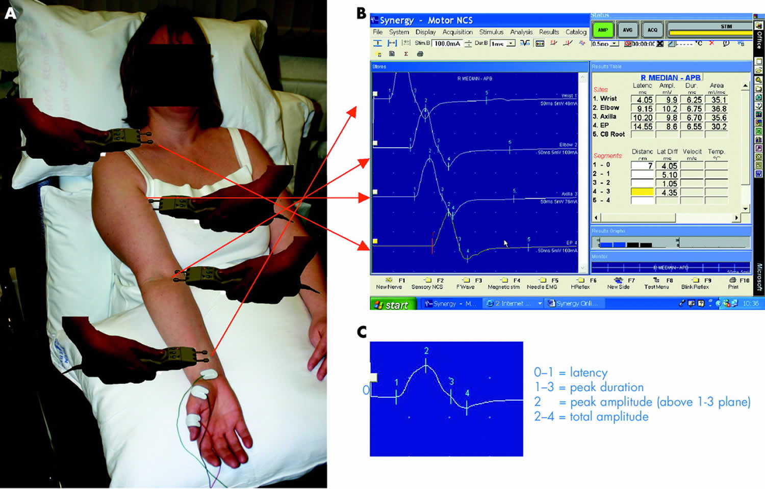 Motor nerve conduction study