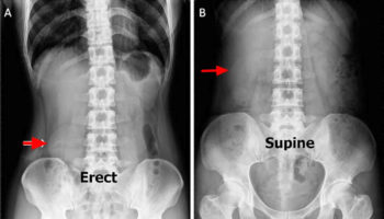 Nephroptosis