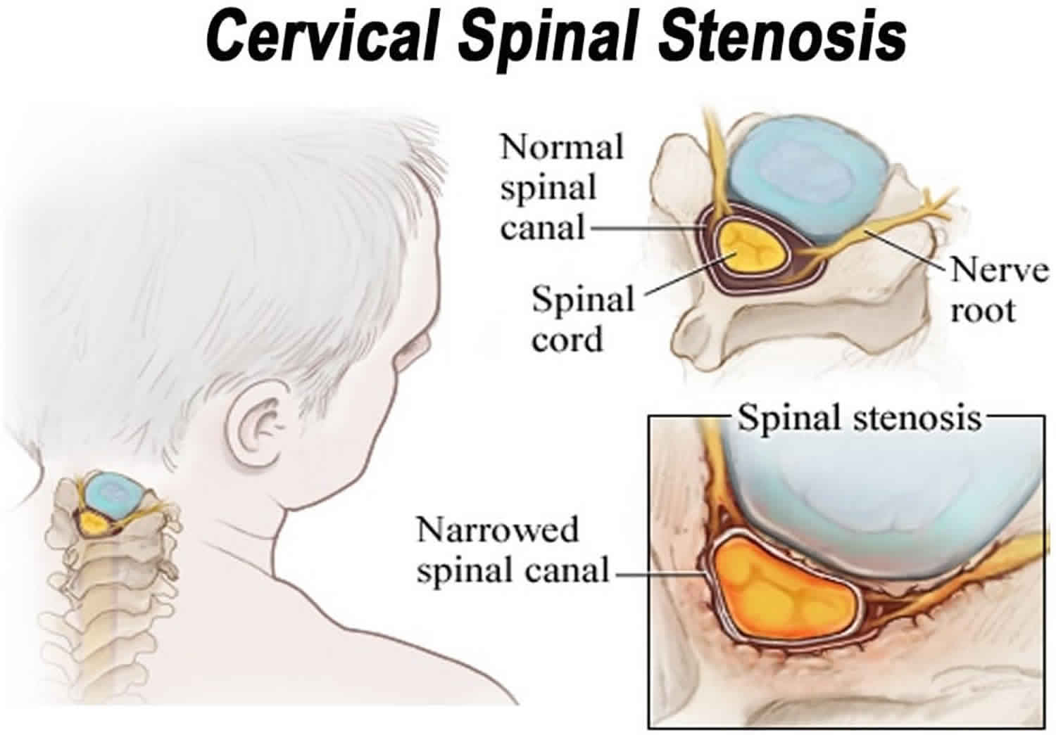 Neural foraminal stenosis of cervical spine