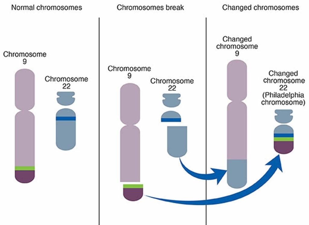 Myelogenous leukemia, acute, chronic, symptoms, diagnosis & treatment