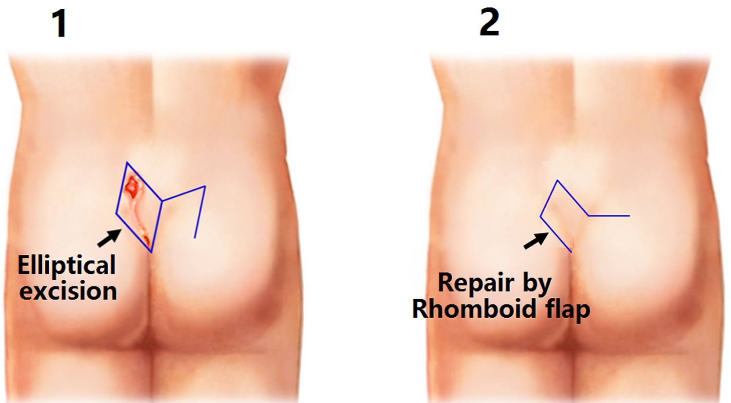 Pilonidal Sinus Definition Causes Symptoms Diagnosis Treatment