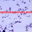 Propionibacterium acnes