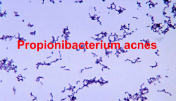 Propionibacterium acnes