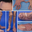 Proteus syndrome