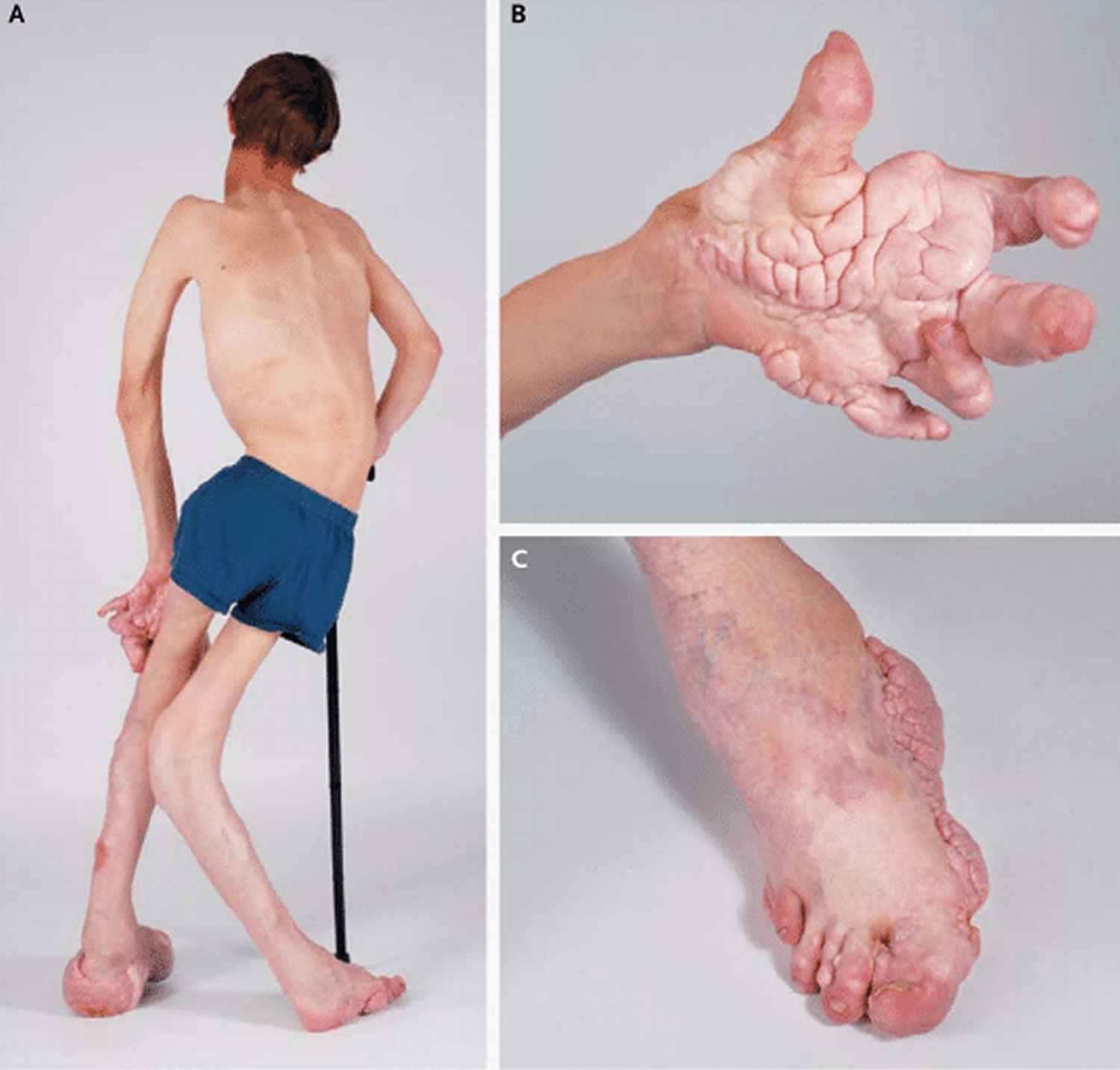 proteus syndrome photos